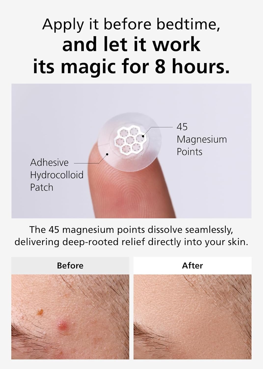 EasyDerm Magnesium Pimple Patches – Hydrocolloid Acne Spot Treatment with Ampoule & Tweezer, 10 Calming Zit Stickers by Daewoong, 이지덤, 대웅제약