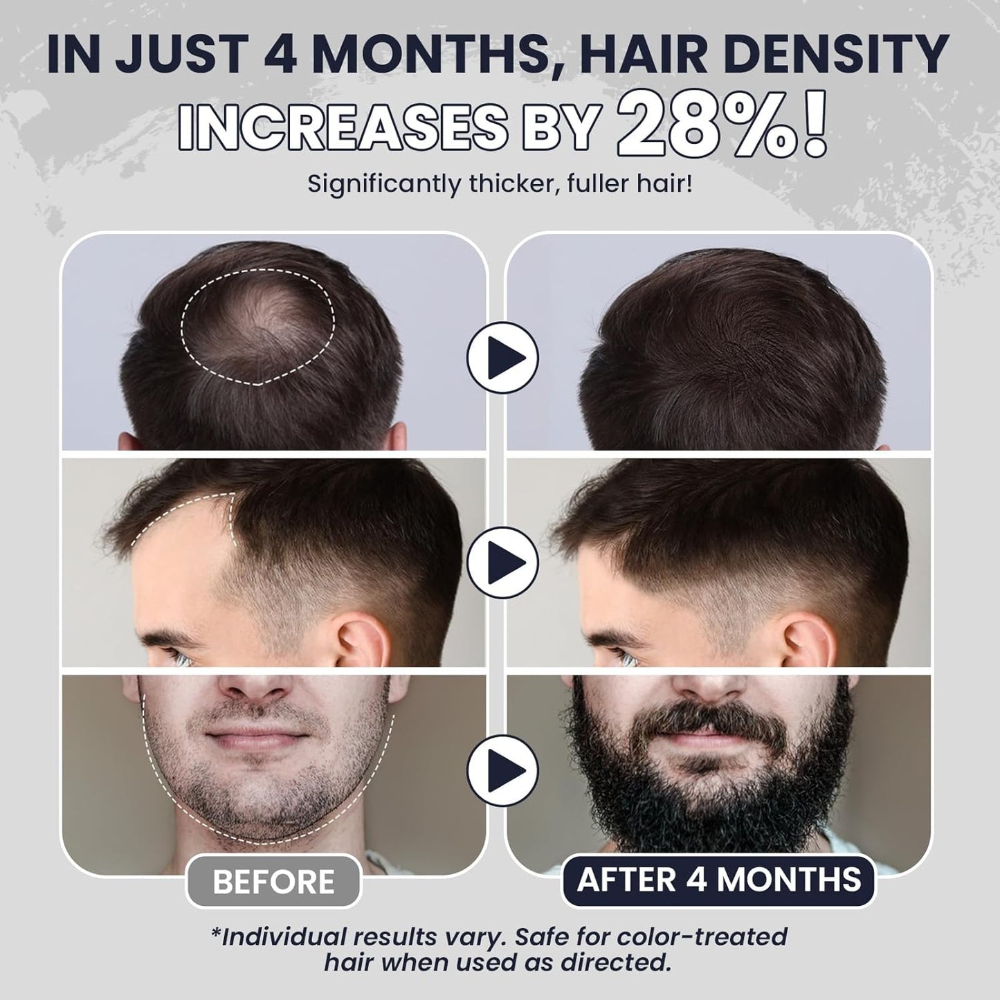 5% Minoxidil for Men Hair Growth Serum Topical Minoxidil Beard Hair Regrowth Thicker Prevent Hair Loss for Thicker Longer Fuller Healthier Hair 3 Bottles of 2oz