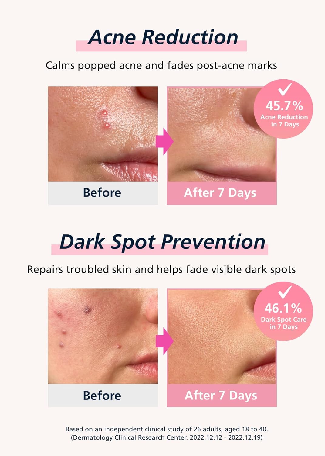 Easyderm Real Calming Patch Microdart Pimple Patches, Clear Nano Micropoint | Niacinamide, Hyaluronic Acid, EGF Acne Dark Spot Care, K-beauty | 12 Counts