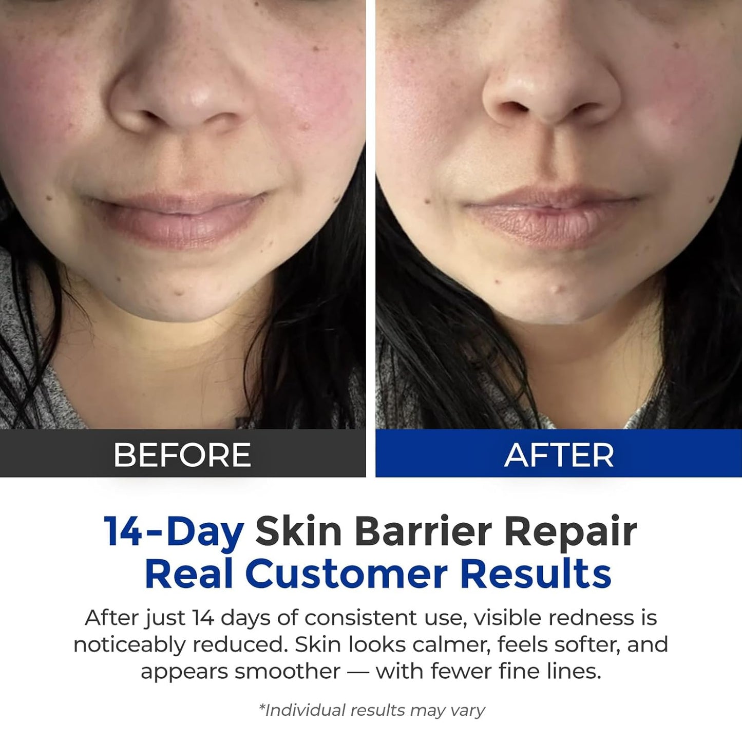 Intensive Repair Serum, 15%Hyaluronic Acid for Sensitive Skin Anti Aging Ultra Hydrating Serum for Face Calming Barrier Repair Redness Relief with Ceramides Centella 30Vials Daily Travel Care