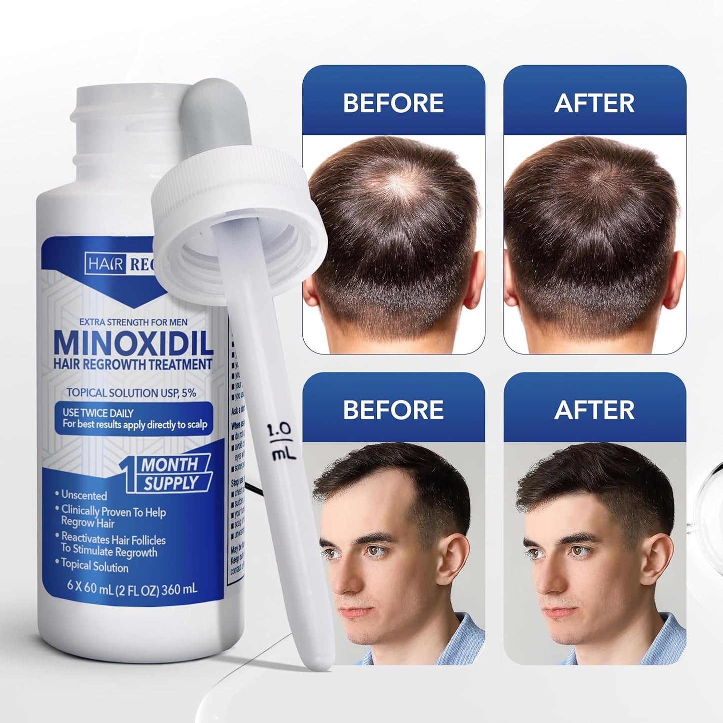 Hair-Regen Advanced 5% Minoxidil For Men Hair Regrowth Treatment for Thinning Hair - Hair Loss for Men - 6 Month Supply, Minoxidil Topical Solution So Thicker Fuller Hair Keeps Growing Amazing Results